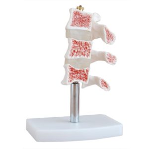 Cutaway Osteoporosis