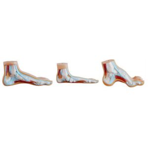 Flat Foot